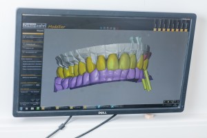 Компьютерная реставрация зубов CAD/CAM и безметалловая керамика